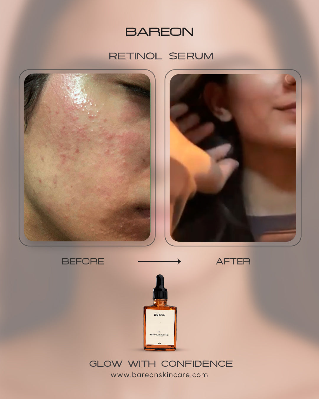 Before and after using Bareon Retinol Repair Serum 0.3%
